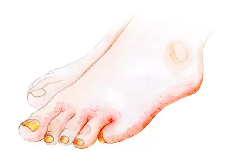 Μύκητας στα δάχτυλα των ποδιών και πώς να εφαρμόσετε κρέμα Zenidol