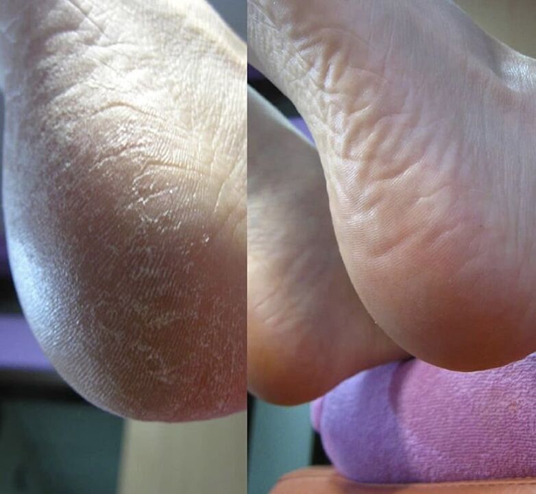 Φωτογραφία της φτέρνας του ποδιού πριν και μετά τη χρήση της κρέμας Zenidol