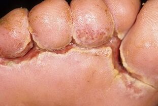 συμπτώματα μύκητα στα νύχια των ποδιών