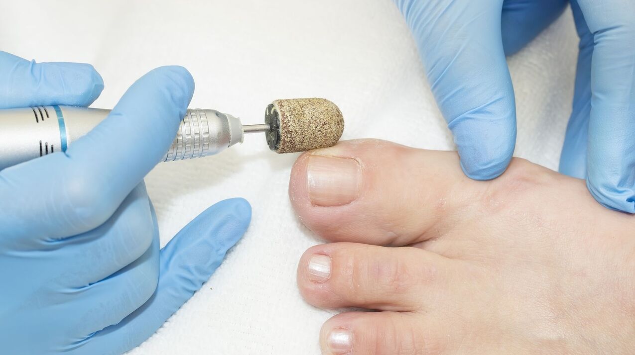 hardware θεραπεία του μύκητα στα νύχια των ποδιών