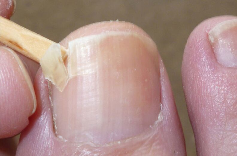 Τα κατεστραμμένα νύχια αποτελούν παράγοντα κινδύνου για μυκητίαση