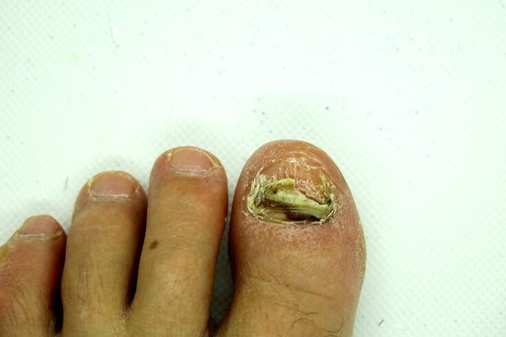 Finger Nail Fungus - βαρύ στάδιο