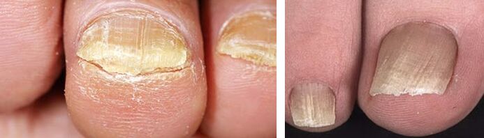 βλάβη στα νύχια με μυκητιασική λοίμωξη